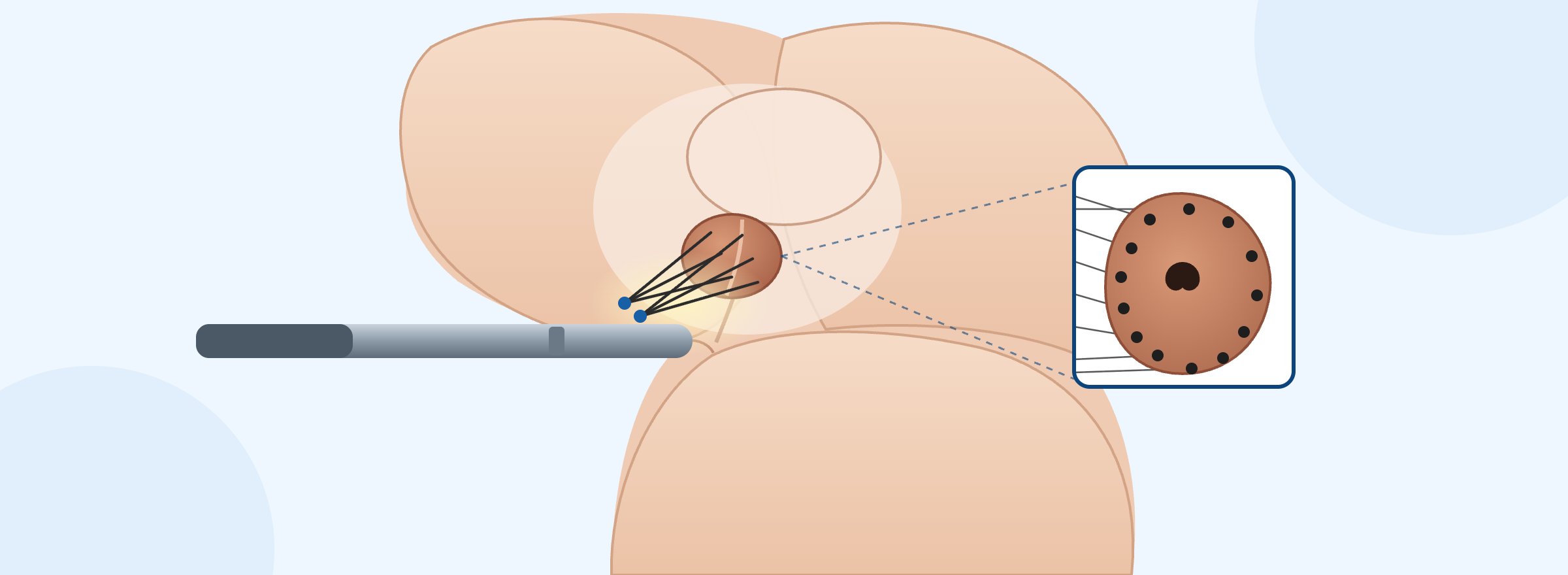 Εικονογράφηση διαπερινεϊκής fusion βιοψίας προστάτη με υπερηχογραφική καθοδήγηση